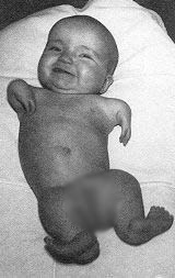 bebe nu flou Thalidomide, Çocukları sakat bırakan ilacın zararları 2