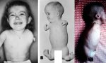 Çocukları Sakat Bırakan İlaç Thalidomide Nedir?