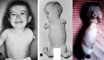 Çocukları Sakat Bırakan İlaç Thalidomide Nedir?