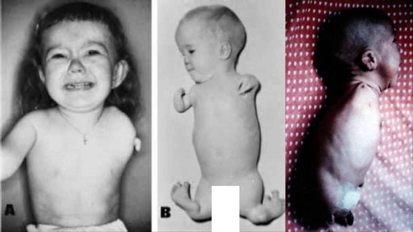 Çocukları Sakat Bırakan İlaç Thalidomide Nedir?