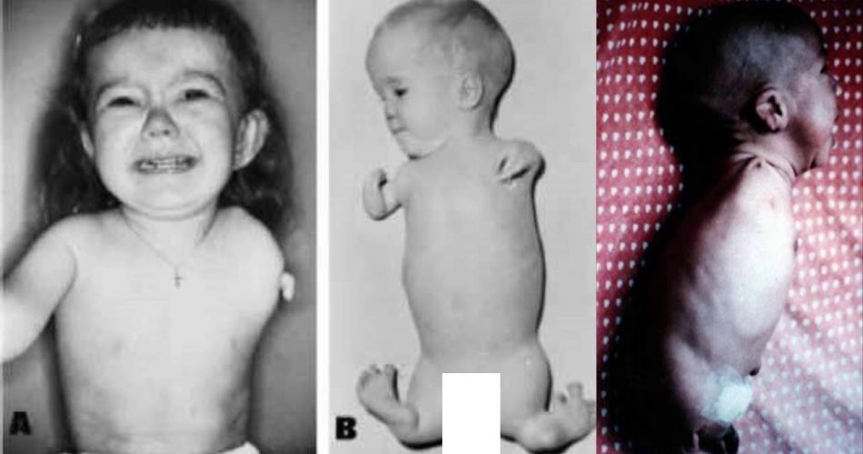 Çocukları Sakat Bırakan İlaç Thalidomide Nedir?