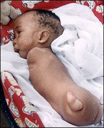 thalidomide baby Thalidomide Baby