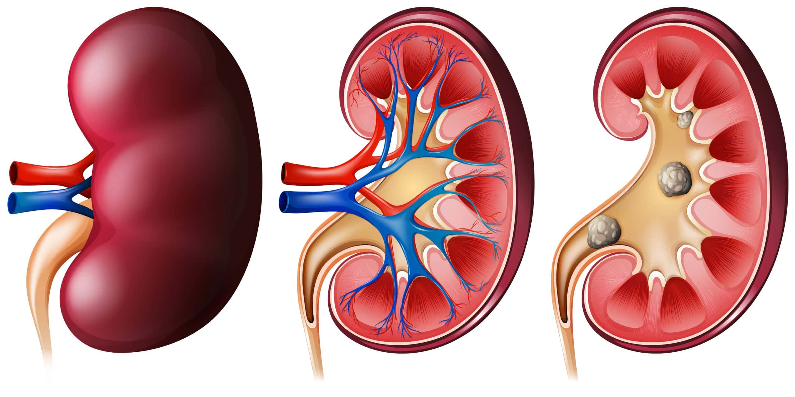 36329 scaled kidney set