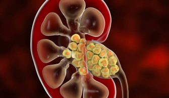 kidney stones, illustration