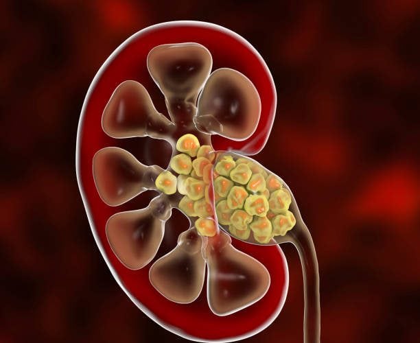 kidney stones, illustration