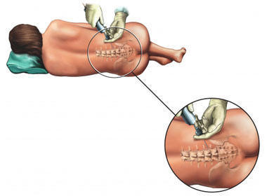 agrisiz epidural dogum agrisiz epidural dogum