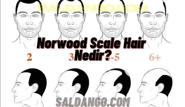 Norwood Scale Hair Nedir