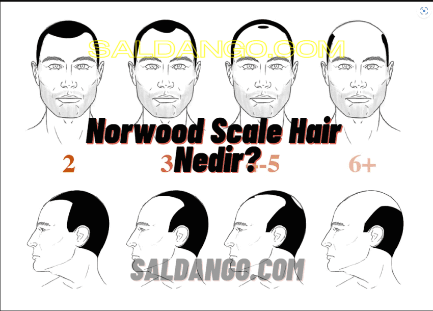 Norwood Ölçeğinin 7 Aşaması 
