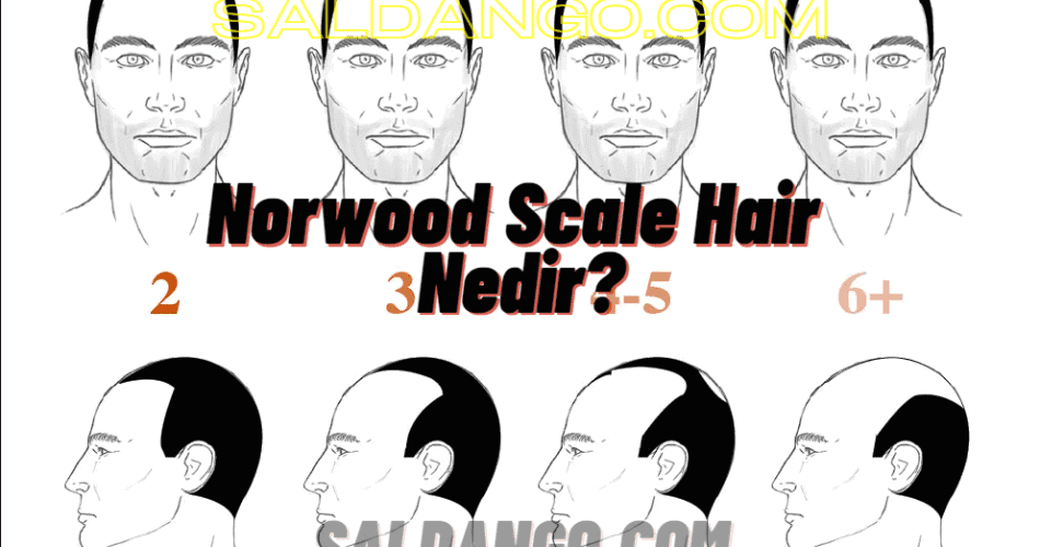 Norwood Scale Hair Nedir